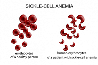 Sickle cell trait may not boost risk of stroke for African Americans thumbnail Photo